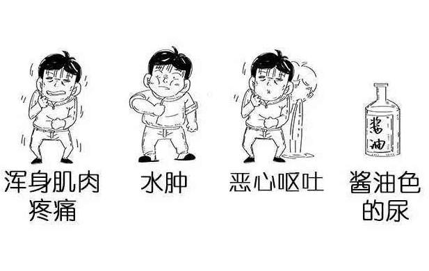 剧烈运动,吃龙虾,通宵玩网游——当心肌肉溶解找上门!