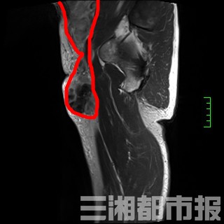 右大腿根部的包块极有可能是3年前右拇趾处发现的恶性黑色素瘤转移