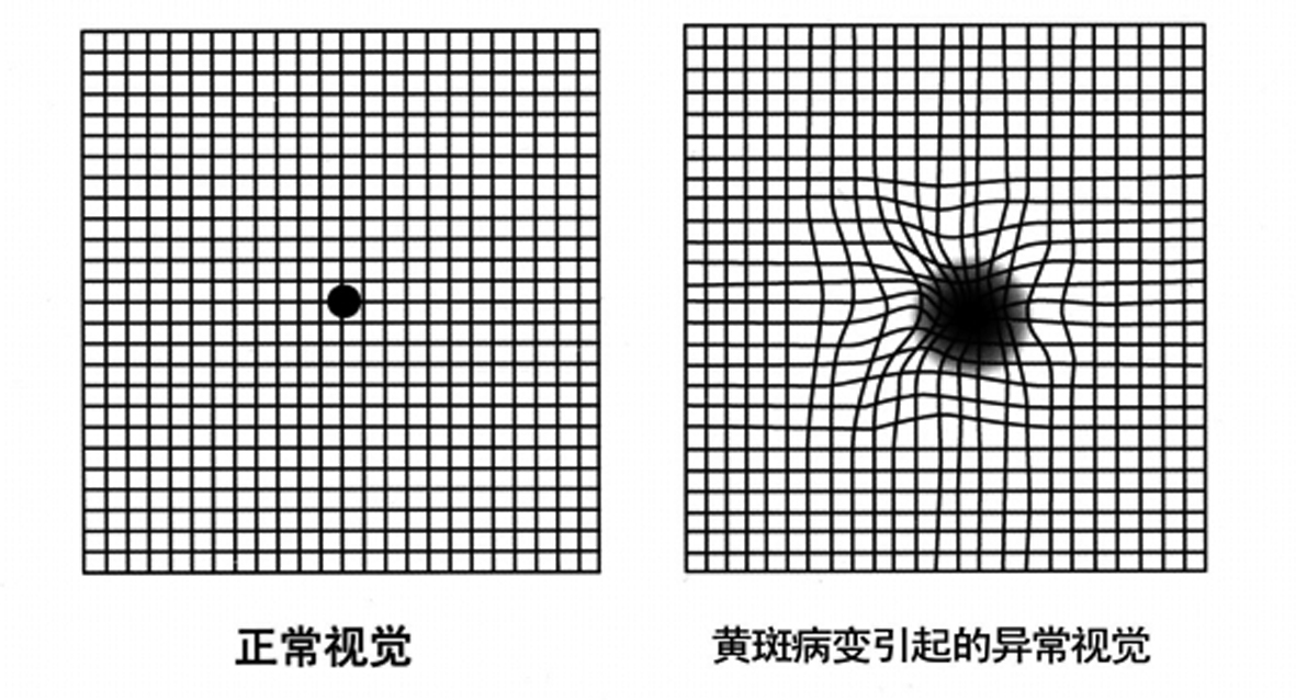 80岁空巢老人视物模糊变形险摔倒这种眼病在老年群体中发病率最高