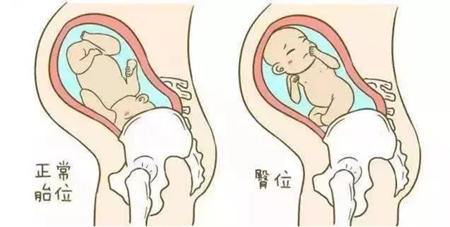 由于宫内环境及胎儿的情况可能随时发生变化,臀位外倒转术对于医生