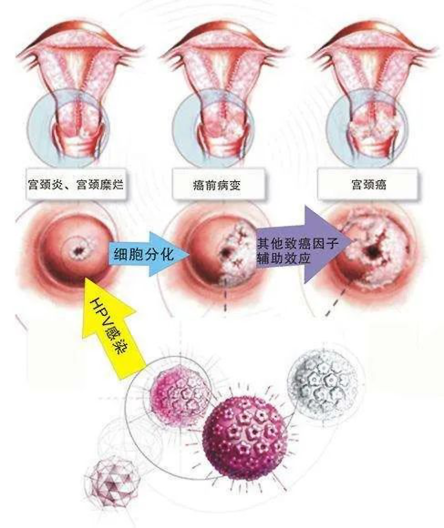 宫颈癌的真实图片图片
