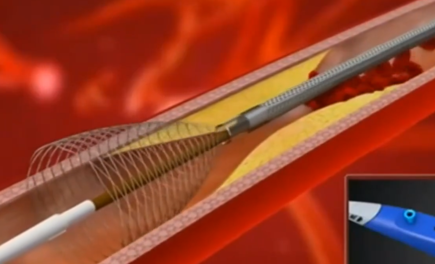 18000到700:心脏支架如何被砍成白菜价?