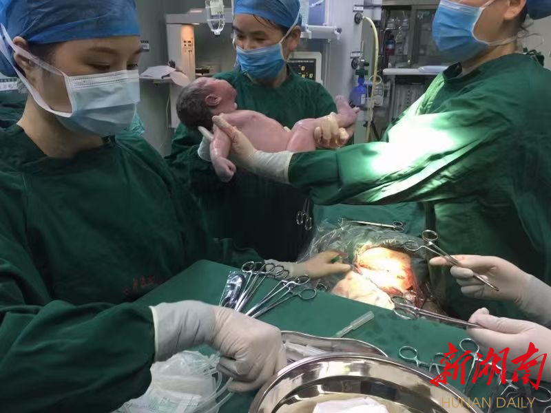 剖腹产手术中 剖腹产手术中