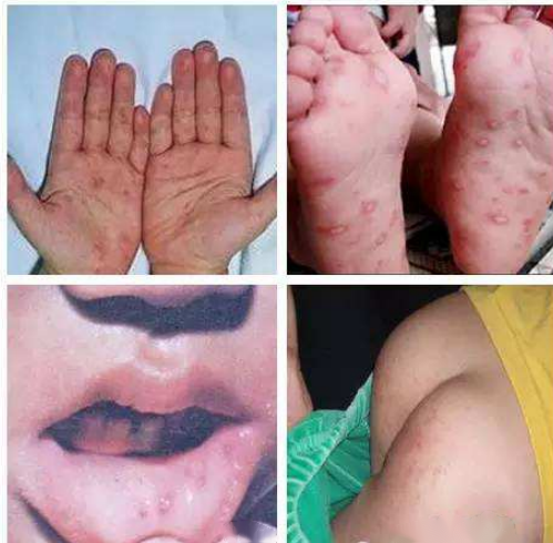 手足口病已进入高发季|宝爸宝妈,这份孩子防护"秘籍"请收好