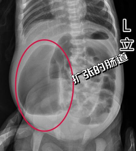 肚子大要小心出生6天女娃胀得像皮球竟是因为没有肛门