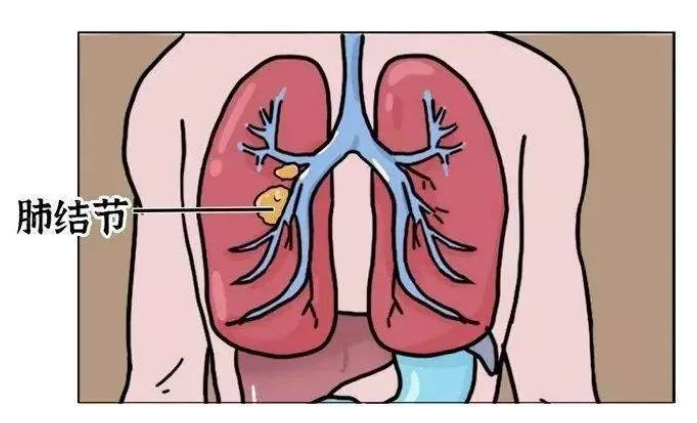 【肺癌科普】发现肺部2类结节怎么办? - 株洲 - 新湖南