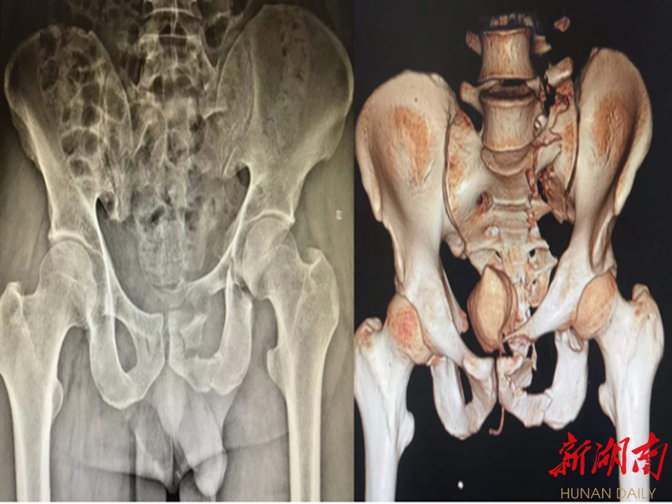 郴州市第一人民医院创伤骨科巧夺天工微创精准治疗复杂骨盆骨折