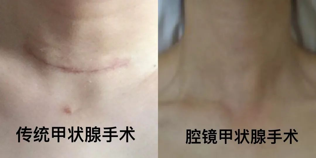 "阮景德主任医师指出"但即使是胸乳,腋窝入路,仍然会留下数个两厘米