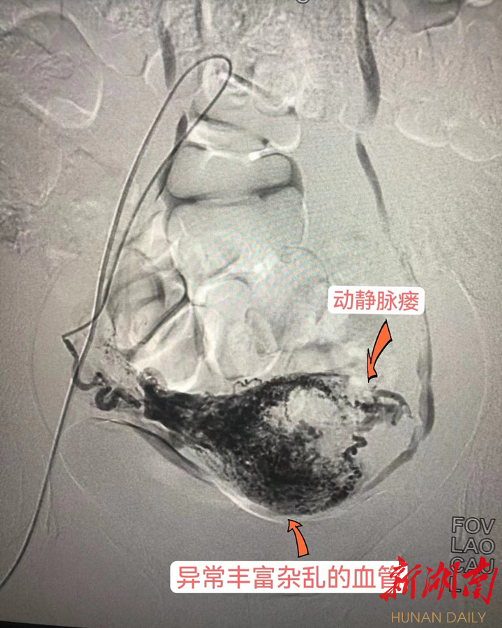 图为患者右侧子宫动脉DSA造影表现。 图为患者右侧子宫动脉DSA造影表现。
