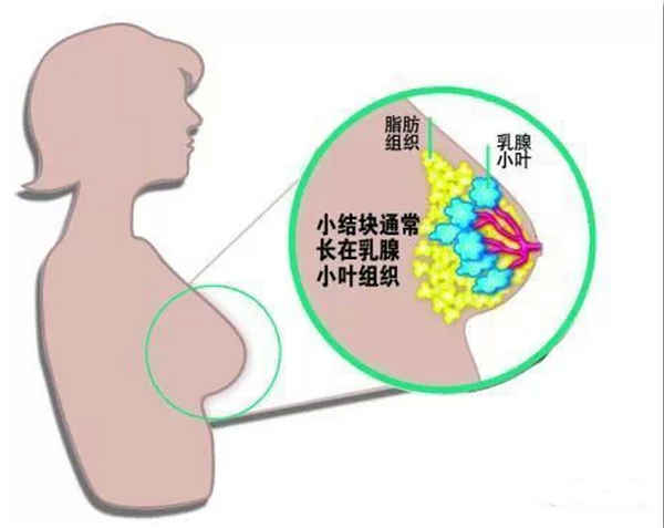 乳腺结节 实例图图片