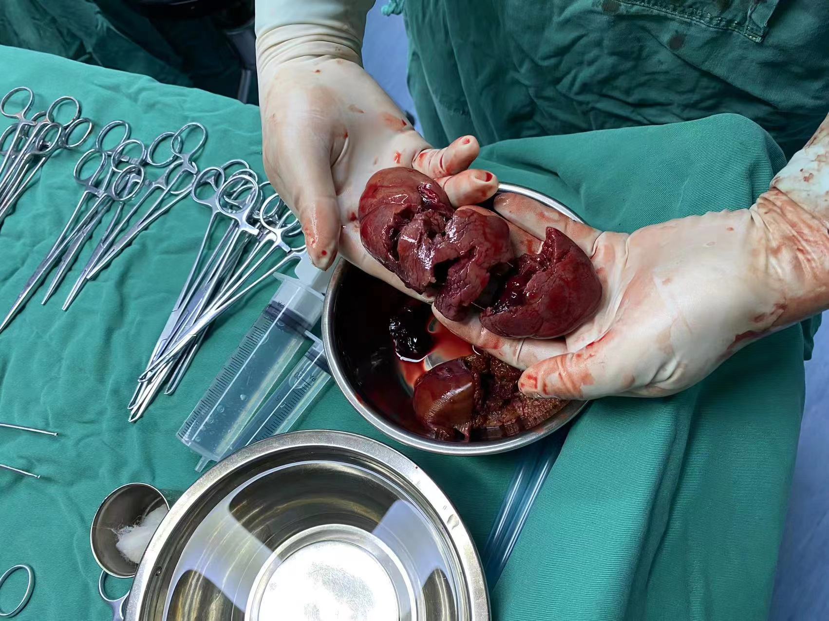 急诊科接诊一个从高处坠落的12岁的女孩,ct检查显示颅脑损伤,肝脏破裂