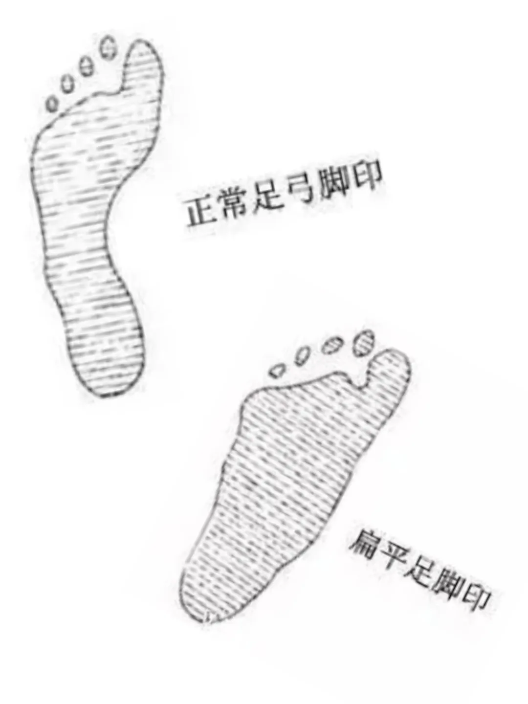而一旦足弓塌陷,支撑作用减弱,身体各个关节的受力情况也会发生变化,>