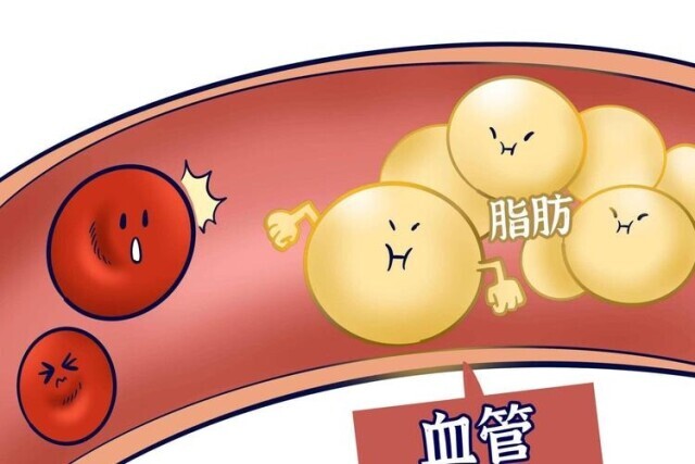 无论年龄大小，都需关注血脂健康