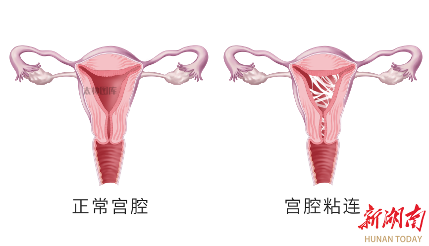 超声小课堂 | 女性宫腔粘连，超声检查这样诊断