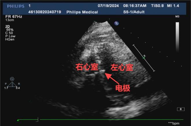 心脏起搏哪种好？只选对的，不选贵的