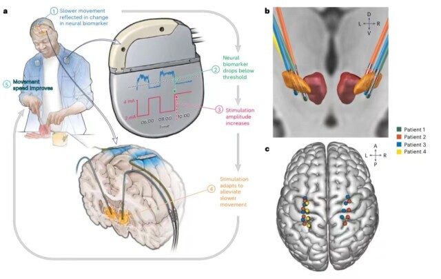個性化深部腦刺激能減輕帕金森癥狀