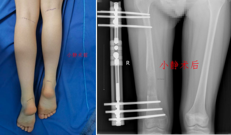 截骨延長巧治畸形｜婁底市骨傷醫(yī)院成功將多例雙腿“落差”患兒拉回“平衡點”