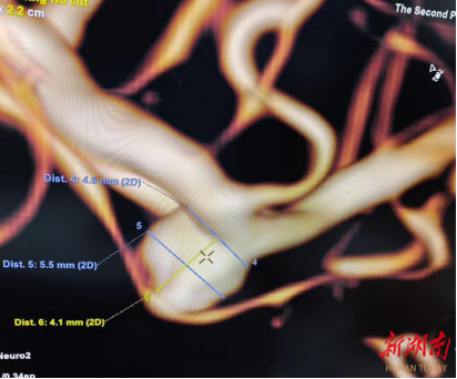 有驚無(wú)險(xiǎn)，WEB植入術(shù)巧拆“復(fù)雜腦動(dòng)脈瘤”