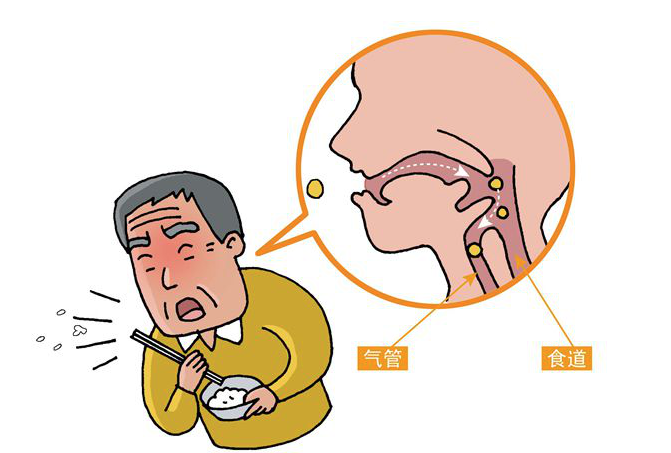 老人喝水吃飯老被嗆到？當(dāng)心吞咽功能障礙！一個(gè)表格可家中自測(cè)