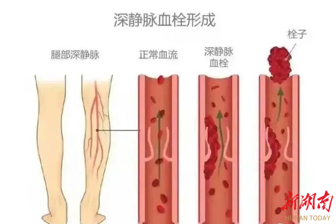 世界血栓日|动起来，别让血栓危害你