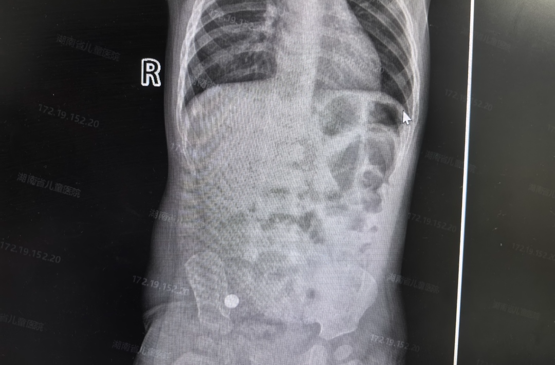 半個月接診14例，取出硬幣、回形針、電池等……兒童消化道異物怎么防？