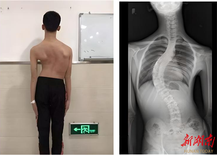 健康科普丨青少年脊柱侧凸：守护青少年脊柱健康