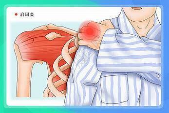 寒冬易发肩周炎 教你8招给肩膀解冻