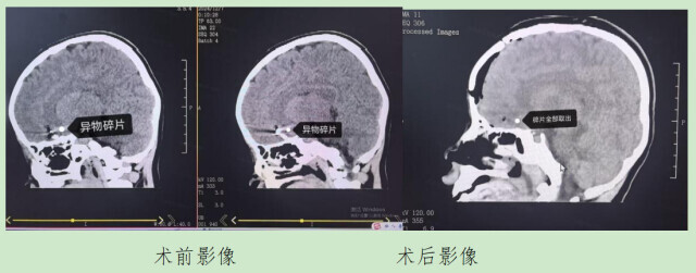 学生不慎将圆珠笔插入颅内！专家：不可贸然拔出穿刺物