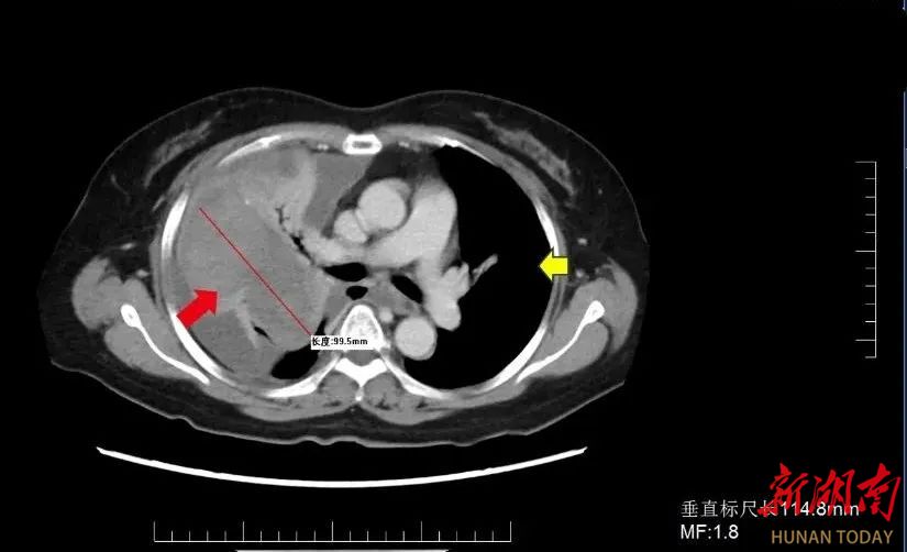 胸闷、咳嗽久未确诊是何故？多学科专家合力揪出“真凶”