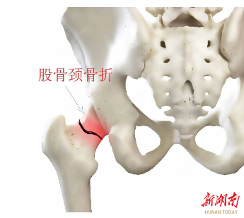 长沙市第一医院：高龄老人骨折 “破局”，术后首日即下床行走