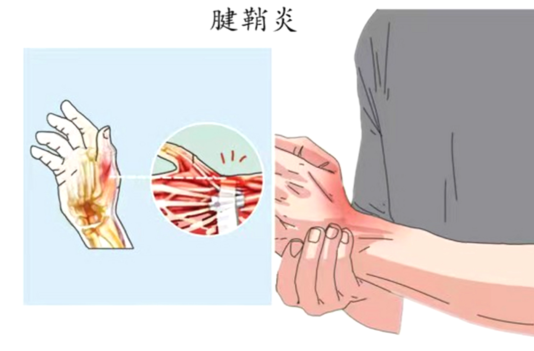 别让腱鞘炎缠上你的手！这些知识一定要知道