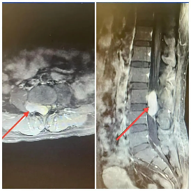 產(chǎn)后長期腰痛竟是椎管內(nèi)腫瘤 ! 新寧縣人民醫(yī)院多學(xué)科協(xié)作排“雷”成功
