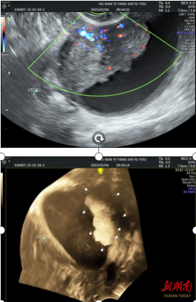 突破！益阳市妇幼保健院成功开展经静脉妇科超声造影新技术