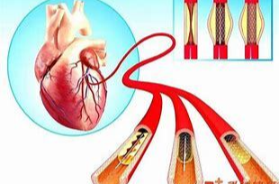 心脏支架手术将逐步被淘汰？真相来了
