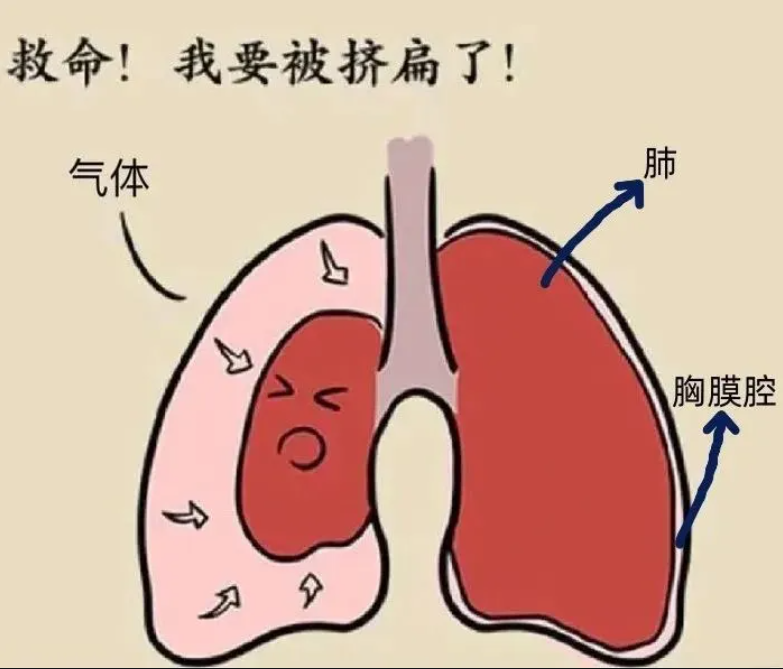 歌手方大同离世引关注，警惕“爆肺”危机，自发性气胸不容忽视！