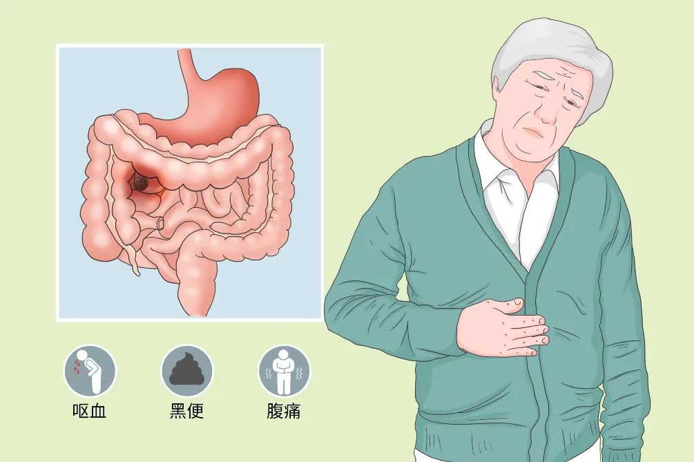 肛周疼痛是“小病”？女子疼1年竟要手术保肛