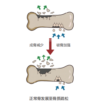 周末·涨知识丨哪些人容易得骨质疏松症？如何预防和改善？一文了解