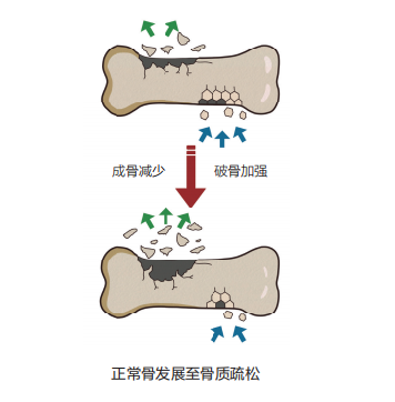 周末涨知识|哪些人容易得骨质疏松症？如何预防和改善？一文了解