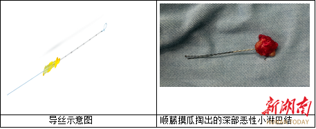 超声引导下定位：精准医疗的