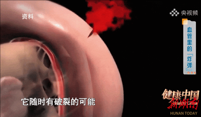 若不及时发现，48小时内死亡率高达50%！这种疾病最近高发！