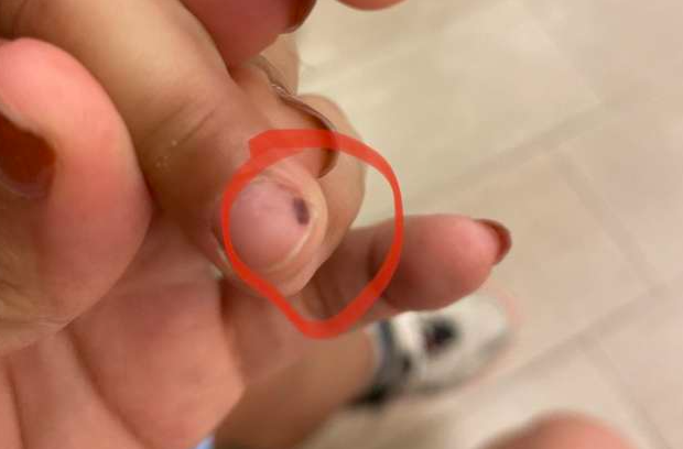 每次指甲有了淤血，你是不是索性“懒得管”？