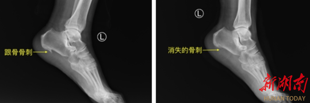 湘雅常德医院关节镜下微创术解决足跟痛难题