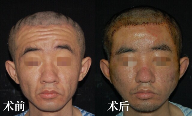 23岁“未老先衰”，湘雅二医院成功为罕见病小伙修复“青春”