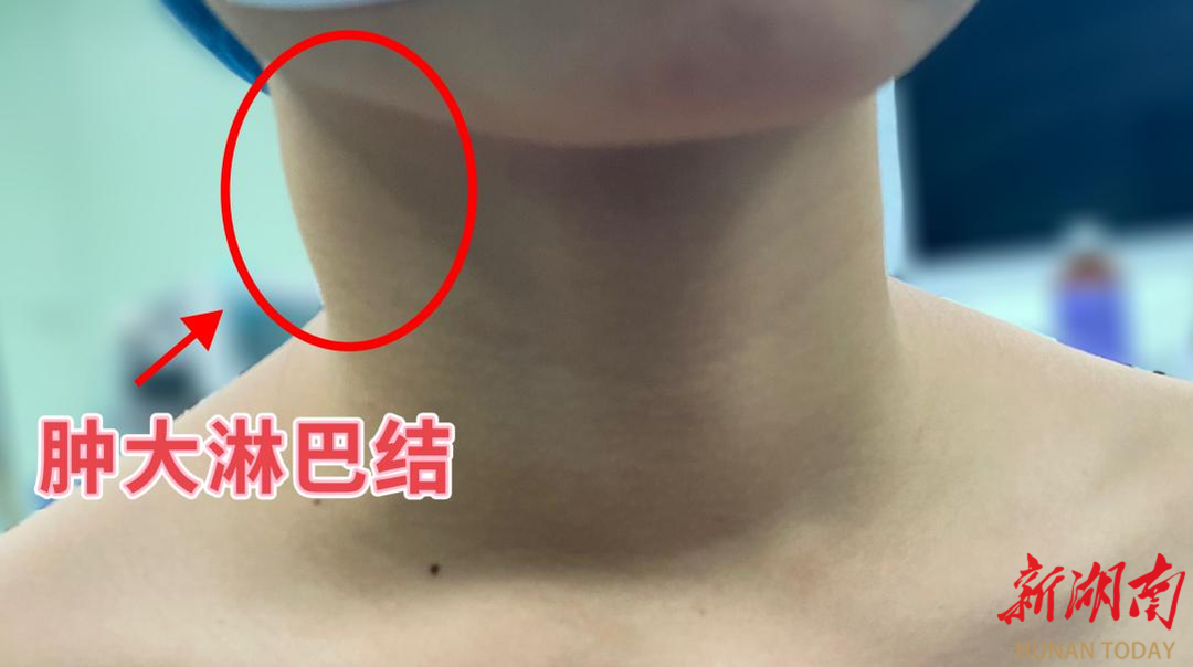 13歲女孩確診甲狀腺癌！警惕脖子上這種無痛“小包塊”