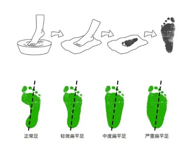 孩子一运动就喊腿痛？当心扁平足！在家自测这样做
