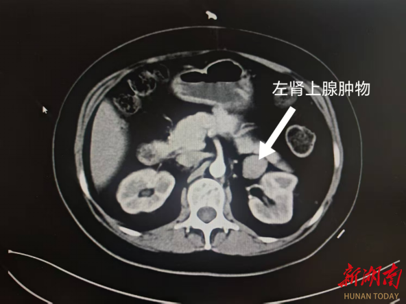 快速發(fā)胖為哪般？ 多學(xué)科聯(lián)手擊退“激素風(fēng)暴”