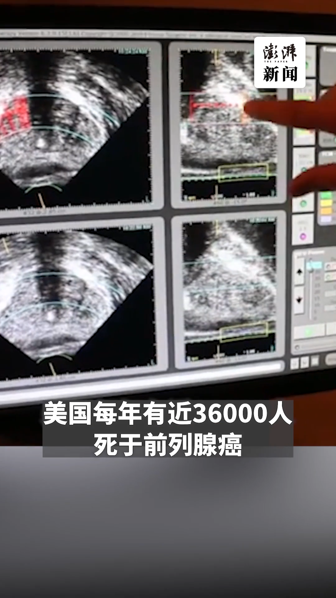 拜登确诊前列腺癌“格里森评分9分”，预后前景如何？