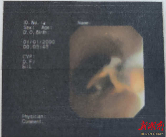 老人肺部感染久不愈，原是辣椒气管“安家”
