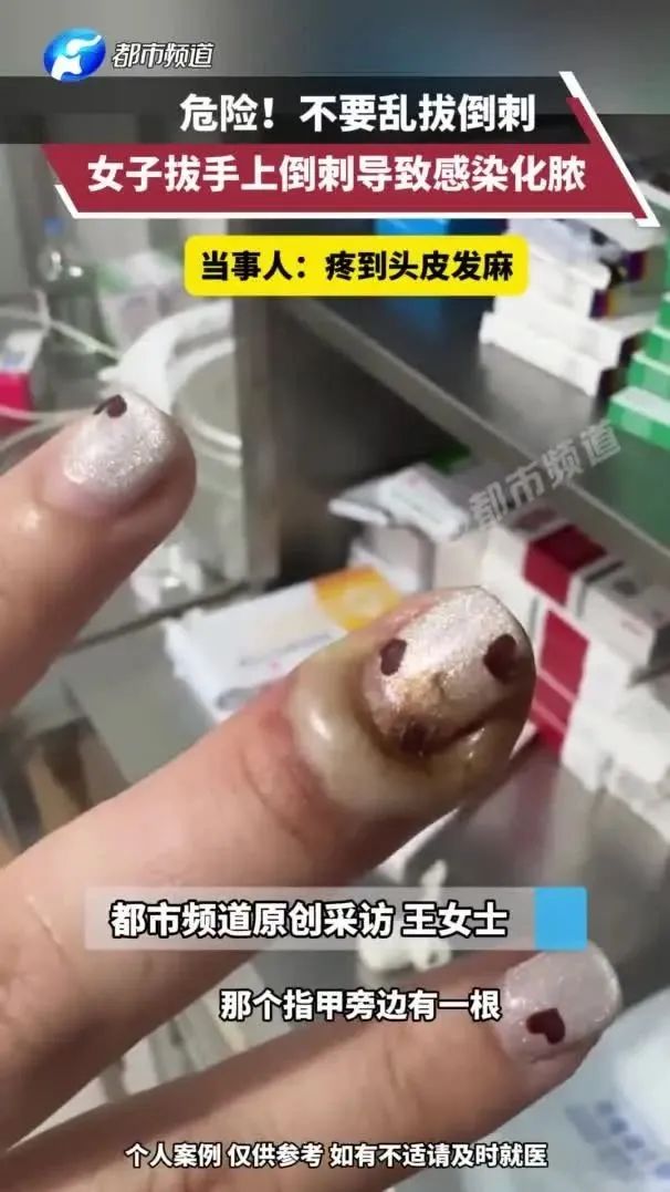 手上这根“刺”拔不得！不当处理会越长越多