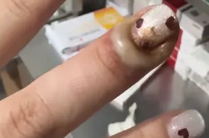 不要拔！不要拔！有人进了急诊、截掉手指……